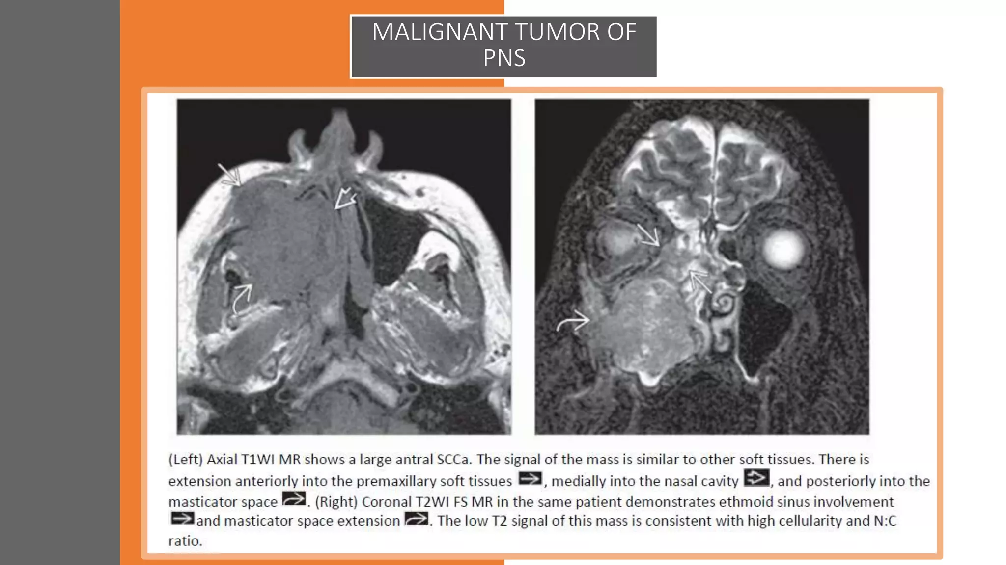 MALIGNANT TUMOR OF
PNS
 