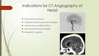 Indications for CT Angiography of
Head
 Intracranial aneurysm
 Cerebral Parenchymal Hemorrhages
 Arteriovenous malformations
 Sub Arachnoid Hemorrhages
 Neoplastic surgeries
 