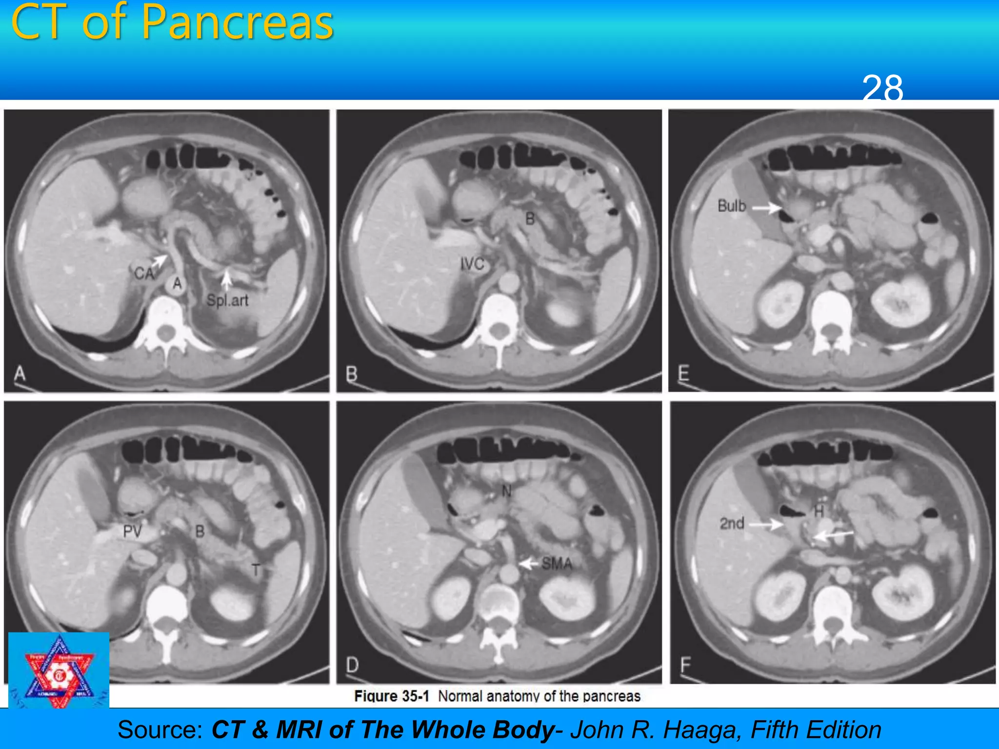 CT of Pancreas
CT Procedure of Abdomen and Pelvis
28
Source: CT & MRI of The Whole Body- John R. Haaga, Fifth Edition
 