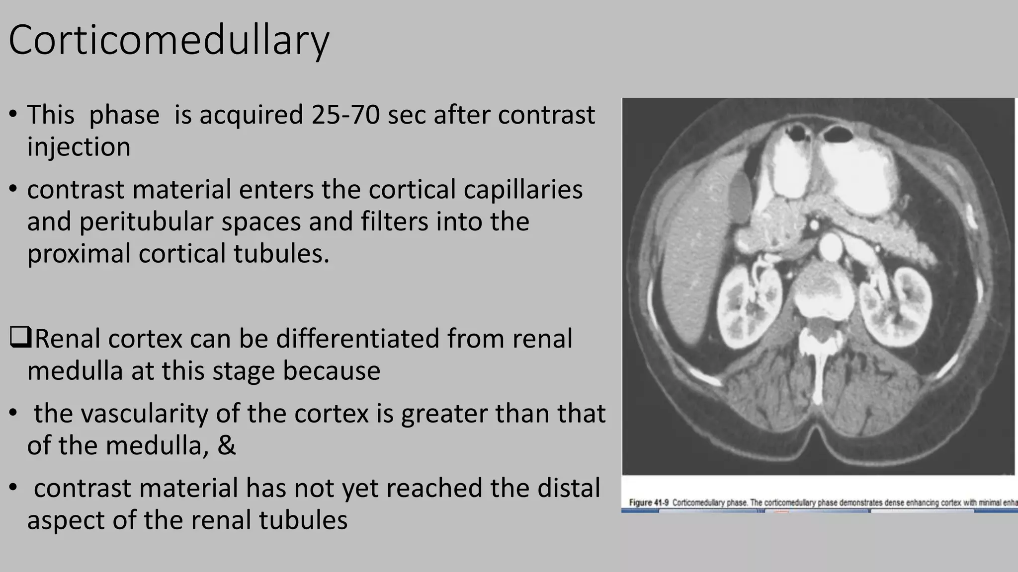 Corticomedullary
• This phase is acquired 25-70 sec after contrast
injection
• contrast material enters the cortical capillaries
and peritubular spaces and filters into the
proximal cortical tubules.
Renal cortex can be differentiated from renal
medulla at this stage because
• the vascularity of the cortex is greater than that
of the medulla, &
• contrast material has not yet reached the distal
aspect of the renal tubules
 