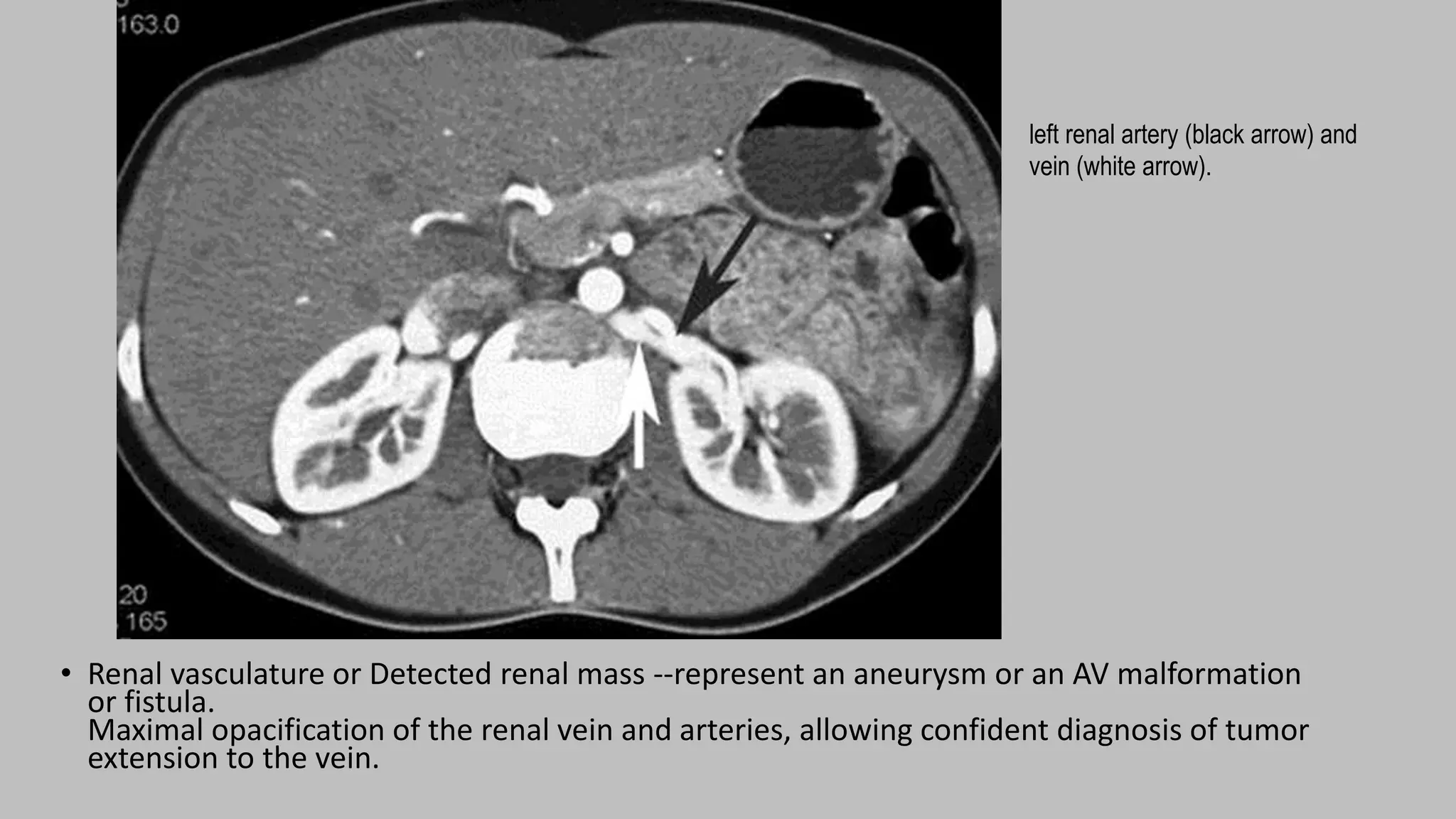• Renal vasculature or Detected renal mass --represent an aneurysm or an AV malformation
or fistula.
Maximal opacification of the renal vein and arteries, allowing confident diagnosis of tumor
extension to the vein.
left renal artery (black arrow) and
vein (white arrow).
 