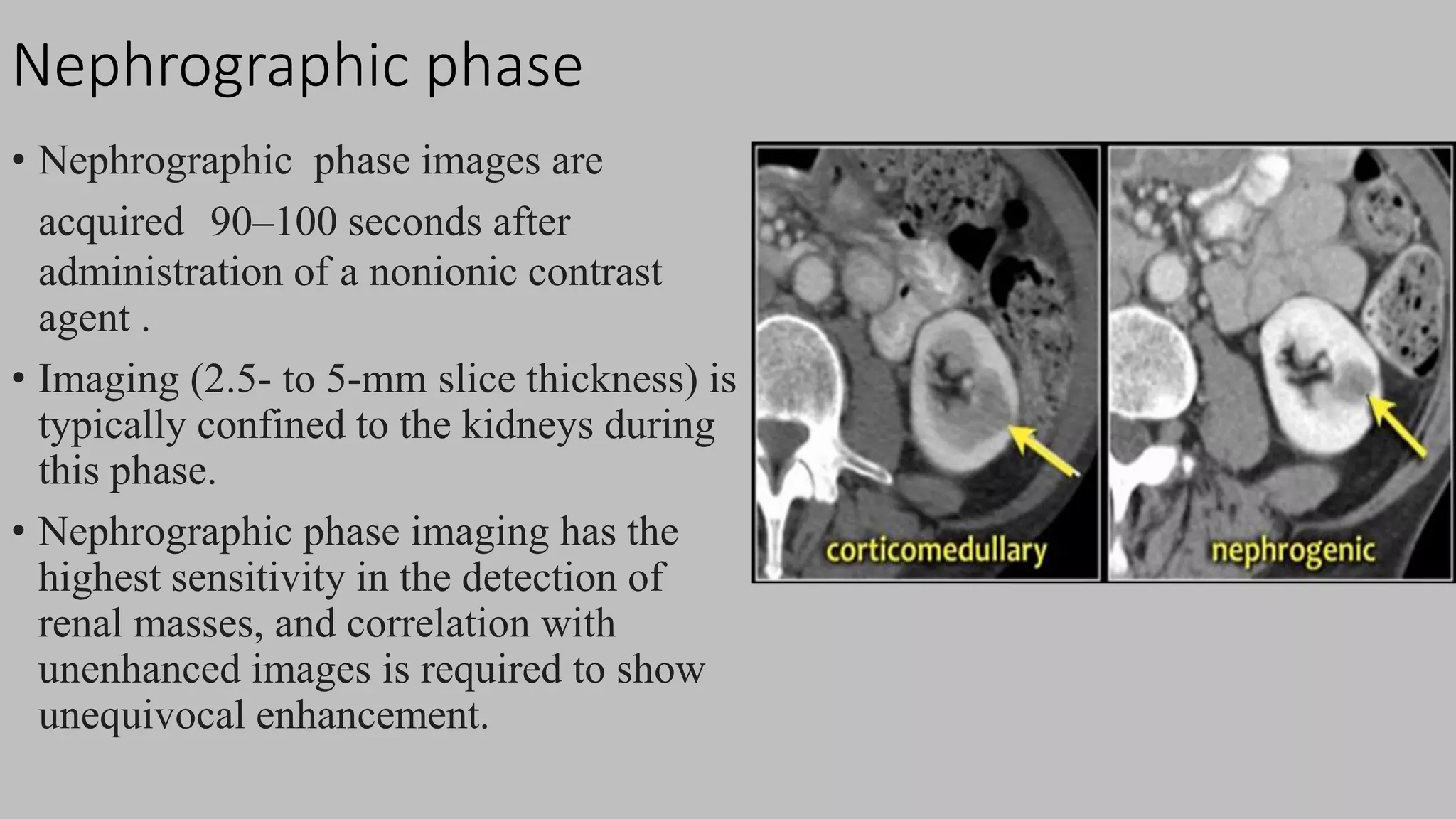 Nephrographic phase
• Nephrographic phase images are
acquired 90–100 seconds after
administration of a nonionic contrast
agent .
• Imaging (2.5- to 5-mm slice thickness) is
typically confined to the kidneys during
this phase.
• Nephrographic phase imaging has the
highest sensitivity in the detection of
renal masses, and correlation with
unenhanced images is required to show
unequivocal enhancement.
 