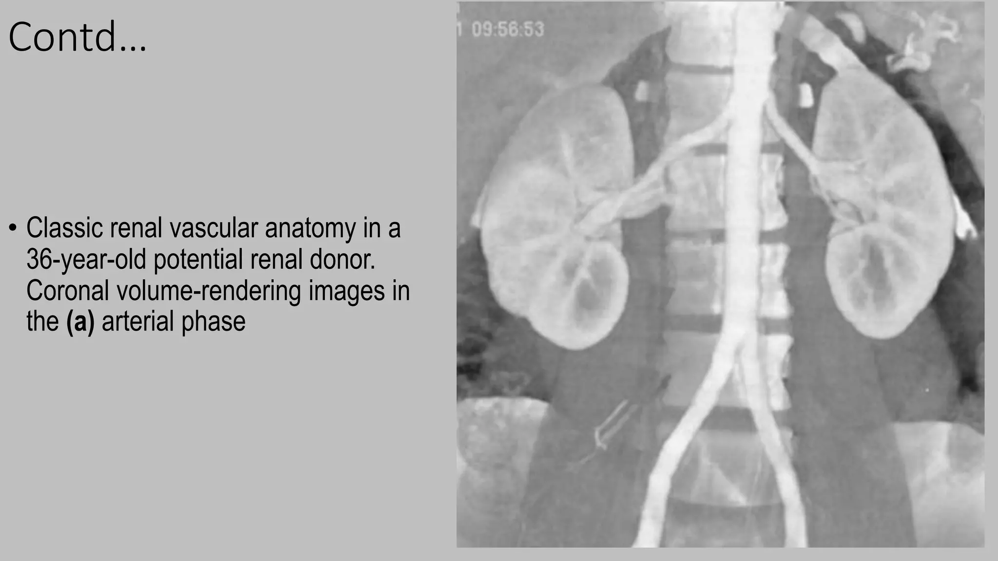 Contd…
• Classic renal vascular anatomy in a
36-year-old potential renal donor.
Coronal volume-rendering images in
the (a) arterial phase
 