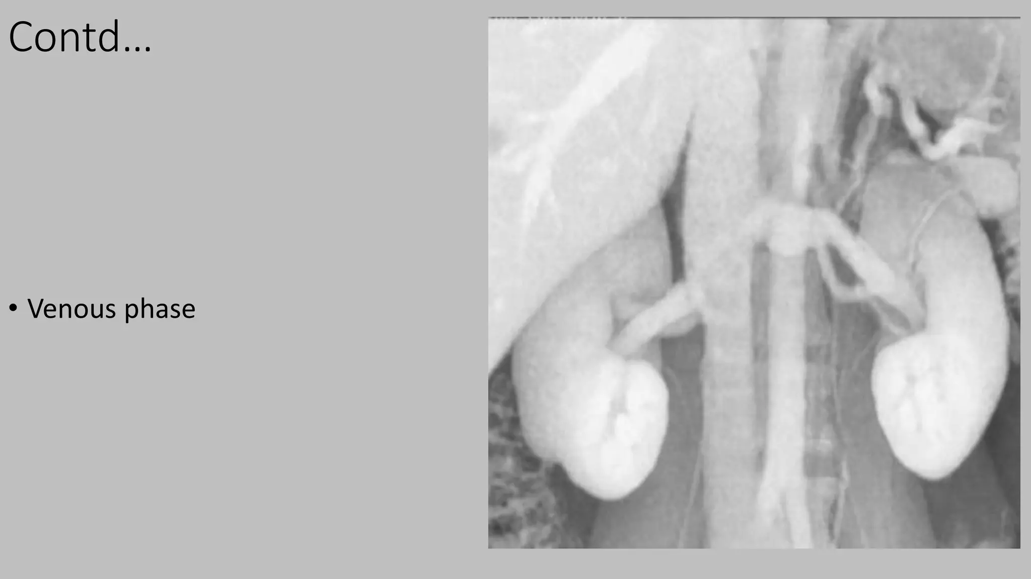 Contd…
• Venous phase
 