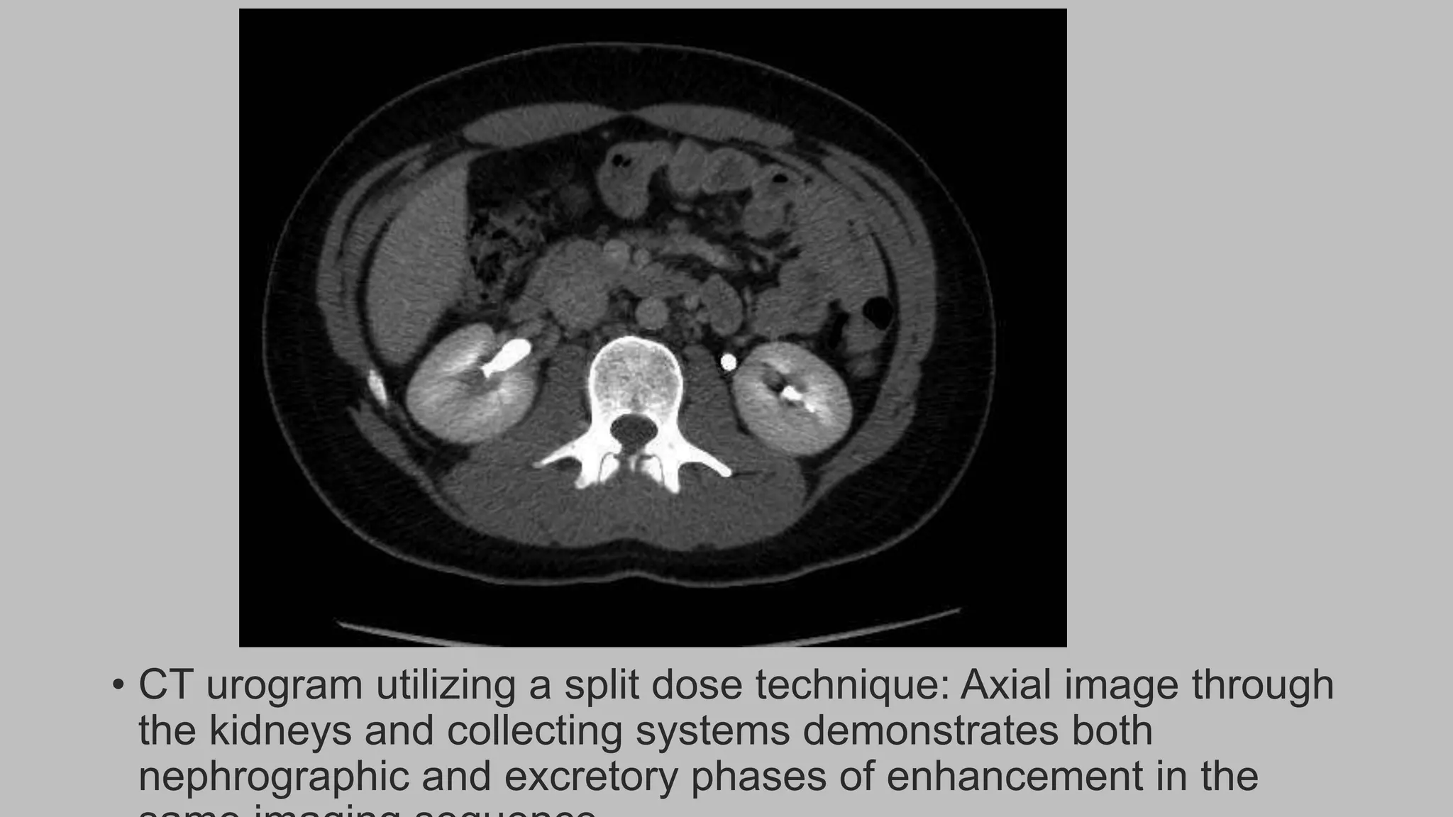 • CT urogram utilizing a split dose technique: Axial image through
the kidneys and collecting systems demonstrates both
nephrographic and excretory phases of enhancement in the
 