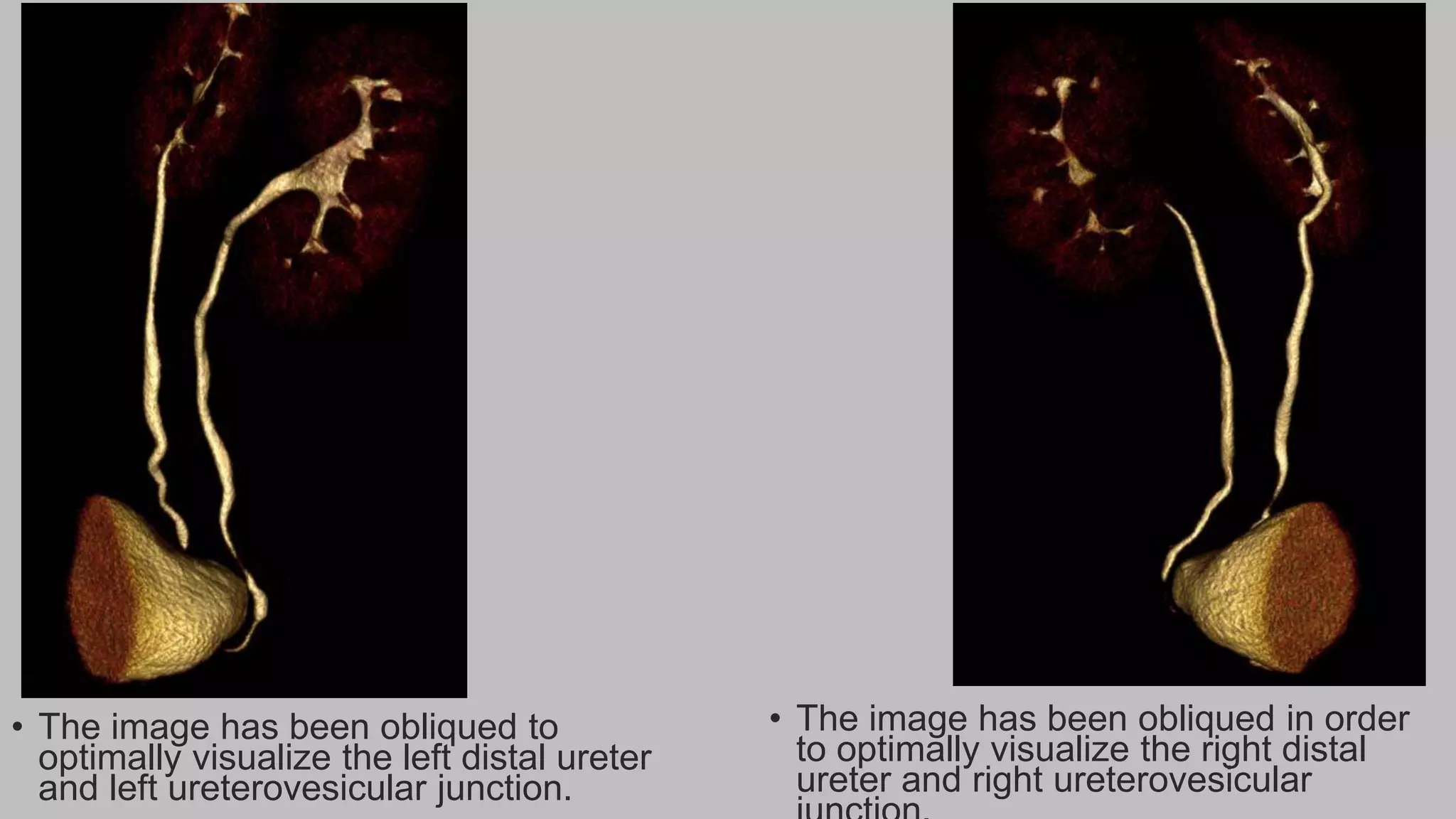 • The image has been obliqued to
optimally visualize the left distal ureter
and left ureterovesicular junction.
• The image has been obliqued in order
to optimally visualize the right distal
ureter and right ureterovesicular
 