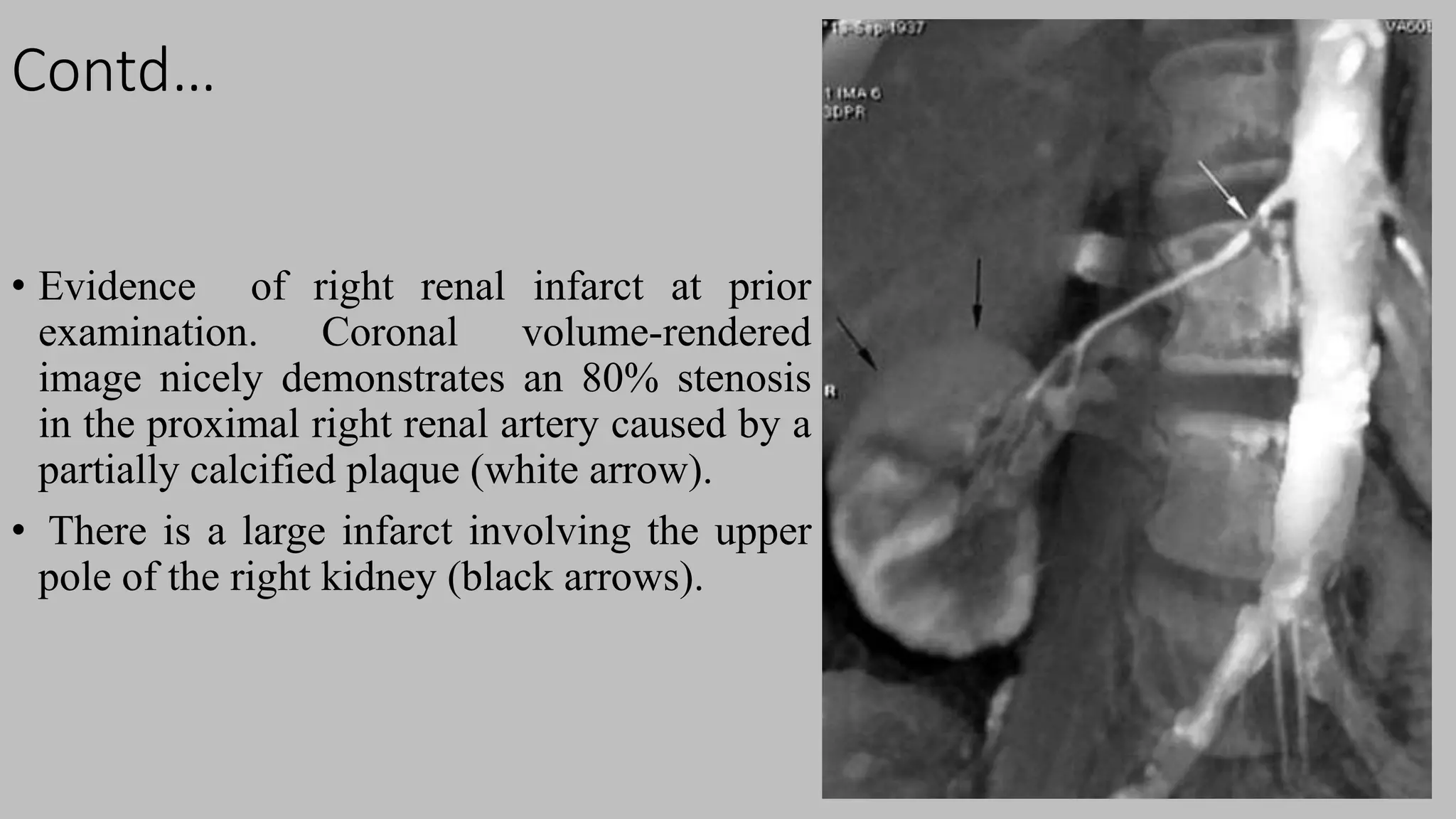 Contd…
• Evidence of right renal infarct at prior
examination. Coronal volume-rendered
image nicely demonstrates an 80% stenosis
in the proximal right renal artery caused by a
partially calcified plaque (white arrow).
• There is a large infarct involving the upper
pole of the right kidney (black arrows).
 