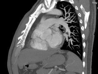  A prominent vein in patients upper limb is catheterised with     18-20 guagevenflon.CONTRAST DOSAGE 1.2ml /kg (body weight) of non-ionic iodinated contrast medium is injected intravenously into the patient using a pressure injector. 