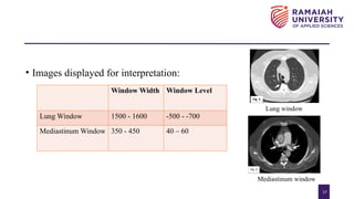 Window Width Window Level CT Pulmonary Angiography Protocol presentation | PPTX