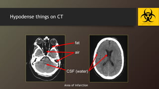 Hypodense things on CT
fat
air
CSF (water)
Area of infarction
 
