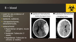 B = blood
• Look for any evidence of
bleeding in:
 epidural, subdural,
 intraparenchymal,
intraventricular,
 subarachnoid
 Hyperdense (bright): Acute
blood
 Isodense: Subacute (1
week)
 Hypodense: Subacute to
chronic (2 weeks)
 