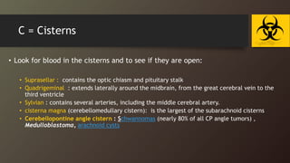 C = Cisterns
• Look for blood in the cisterns and to see if they are open:
• Suprasellar : contains the optic chiasm and pituitary stalk
• Quadrigeminal : extends laterally around the midbrain, from the great cerebral vein to the
third ventricle
• Sylvian : contains several arteries, including the middle cerebral artery.
• cisterna magna (cerebellomedullary cistern): is the largest of the subarachnoid cisterns
• Cerebellopontine angle cistern : Schwannomas (nearly 80% of all CP angle tumors) ,
Medulloblastoma, arachnoid cysts
 