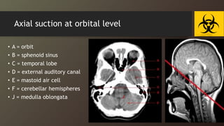 Axial suction at orbital level
• A = orbit
• B = sphenoid sinus
• C = temporal lobe
• D = external auditory canal
• E = mastoid air cell
• F = cerebellar hemispheres
• J = medulla oblongata J
 