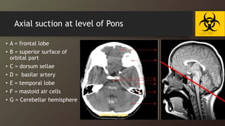 Axial suction at level of Pons
• A = frontal lobe
• B = superior surface of
orbital part
• C = dorsum sellae
• D = basilar artery
• E = temporal lobe
• F = mastoid air cells
• G = Cerebellar hemisphere FM
Pons
cisterna magna
 