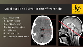 Axial suction at level of the 4th ventricle
• A . Frontal lobe
• B. sylvian Fissure
• C . Temporal lobe
• D . Suprasellar cistern
• E . Midbrain
• F . 4th ventricle
• G . Cerebellar hemisphere
 