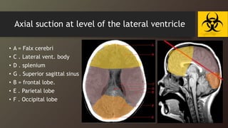 Axial suction at level of the lateral ventricle
• A = Falx cerebri
• C . Lateral vent. body
• D . splenium
• G . Superior sagittal sinus
• B = frontal lobe.
• E . Parietal lobe
• F . Occipital lobe
3rd vent
 