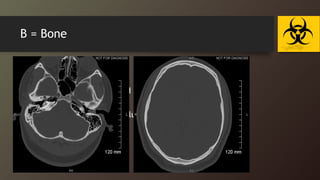 B = Bone
• Examine by bone window :
• fractures
• evaluate the sinuses for fluid or soft tissues accumulation
• Mastoid air cell
• Fluid in the sinus may be a clue to a facial injury !!
 
