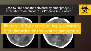 Case :A Flat neonate delivered by emergency C/S
after abruption placenta , CPR done in OR room
Bilateral diffuse cerebral hypo-densities.
Mild dilatation of the ventricular system.
 