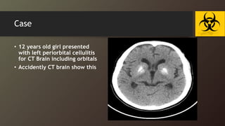 Case
• 12 years old girl presented
with left periorbital cellulitis
for CT Brain including orbitals
• Accidently CT brain show this
 
