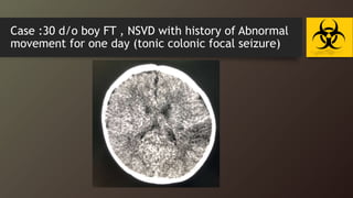Case :30 d/o boy FT , NSVD with history of Abnormal
movement for one day (tonic colonic focal seizure)
 