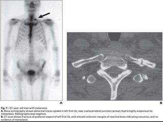 CT scan of Rib pathologies | PPTX