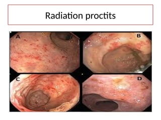 Radiation proctits
 