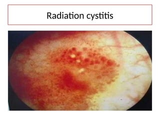 Radiation cystitis
 