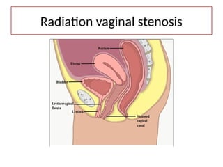 Radiation vaginal stenosis
 