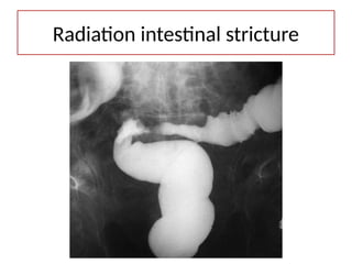 Radiation intestinal stricture
 