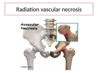 Radiation vascular necrosis
 