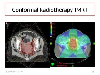 11/03/2025 01:07:16 AM 29
Conformal Radiotherapy-IMRT
 