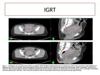 IGRT
 