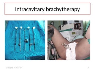 Intracavitary brachytherapy
11/03/2025 01:07:17 AM 33
 