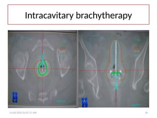 11/03/2025 01:07:17 AM 34
Intracavitary brachytherapy
 