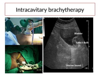 Intracavitary brachytherapy
11/03/2025 01:07:17 AM 35
Uterine Sound
Foley’s Bulb
Bladder
 