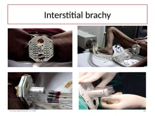 Interstitial brachy
11/03/2025 01:07:17 AM 36
 