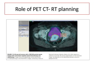 Role of PET CT- RT planning
 