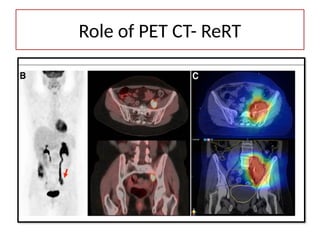 Role of PET CT- ReRT
 
