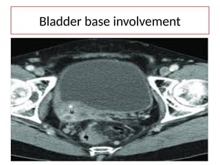 11/03/2025 72
Bladder base involvement
 