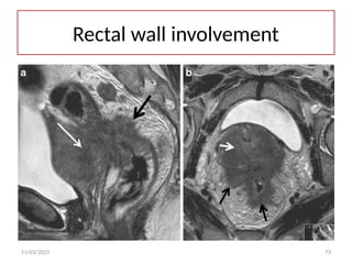 11/03/2025 73
Rectal wall involvement
 