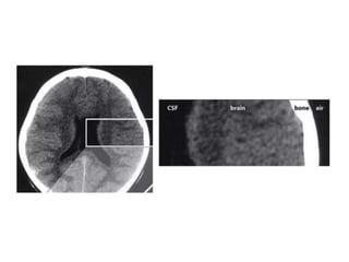 Axial CT slice at the level of the lateral ventricles
 
