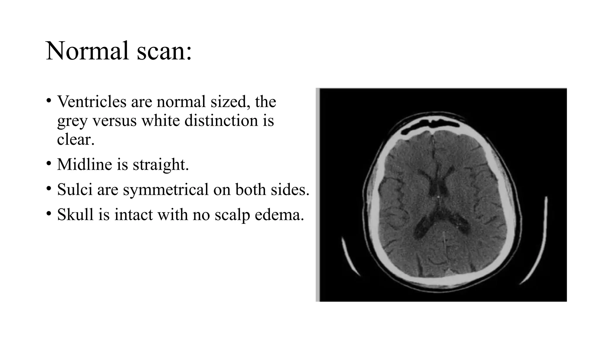 Normal scan:
• Ventricles are normal sized, the
grey versus white distinction is
clear.
• Midline is straight.
• Sulci are symmetrical on both sides.
• Skull is intact with no scalp edema.
 