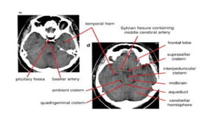 COMPUTED TOMOGRAPHY (CT)simple way to learn | PPTX