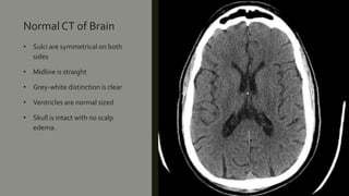 Normal CT of Brain
• Sulci are symmetrical on both
sides
• Midline is straight
• Grey-white distinction is clear
• Ventricles are normal sized
• Skull is intact with no scalp
edema.
 
