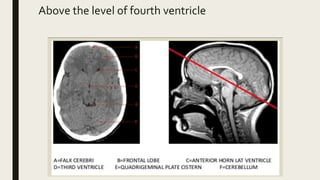 Above the level of fourth ventricle
 