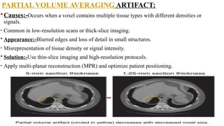 PARTIAL VOLUME AVERAGING ARTIFACT:
Causes:-Occurs when a voxel contains multiple tissue types with different densities or
signals.
• Common in low-resolution scans or thick-slice imaging.
 Appearance:-Blurred edges and loss of detail in small structures.
• Misrepresentation of tissue density or signal intensity.
 Solution:-Use thin-slice imaging and high-resolution protocols.
• Apply multi-planar reconstruction (MPR) and optimize patient positioning.
 
