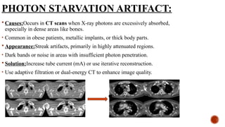 PHOTON STARVATION ARTIFACT:
 Causes:Occurs in CT scans when X-ray photons are excessively absorbed,
especially in dense areas like bones.
• Common in obese patients, metallic implants, or thick body parts.
 Appearance:Streak artifacts, primarily in highly attenuated regions.
• Dark bands or noise in areas with insufficient photon penetration.
 Solution:Increase tube current (mA) or use iterative reconstruction.
• Use adaptive filtration or dual-energy CT to enhance image quality.
 