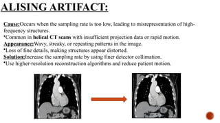 ALISING ARTIFACT:
Cause:Occurs when the sampling rate is too low, leading to misrepresentation of high-
frequency structures.
•Common in helical CT scans with insufficient projection data or rapid motion.
Appearance:Wavy, streaky, or repeating patterns in the image.
•Loss of fine details, making structures appear distorted.
Solution:Increase the sampling rate by using finer detector collimation.
•Use higher-resolution reconstruction algorithms and reduce patient motion.
 