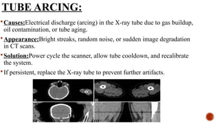 TUBE ARCING:
Causes:Electrical discharge (arcing) in the X-ray tube due to gas buildup,
oil contamination, or tube aging.
Appearance:Bright streaks, random noise, or sudden image degradation
in CT scans.
Solution:Power cycle the scanner, allow tube cooldown, and recalibrate
the system.
If persistent, replace the X-ray tube to prevent further artifacts.
 