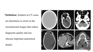  Definition: Artifacts in CT scans
are distortions or errors in the
reconstructed images that reduce
diagnostic quality and can
obscure important anatomical
details.
 